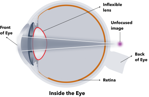 View inside eyeball showing how an inflexible lens can cause an unfocused image